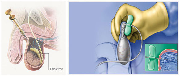 With you sperm collection procedures answer matchless Excited sperm collection procedures