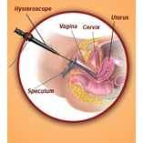 Fertility Preservation