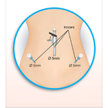 Fertility Preservation