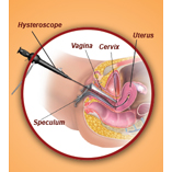 Fertility Preservation
