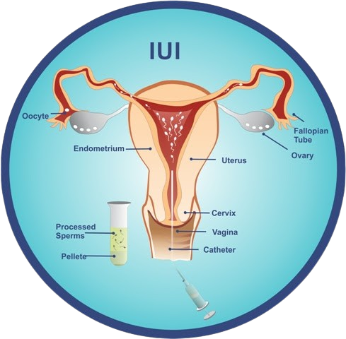 IUI Procedure